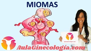 MIOMAS Síntomas diagnóstico y tratamiento de los miomas  Ginecología y Obstetricia [upl. by Adi]