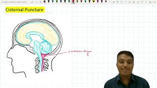 Cisternal Puncture  Suboccipital Puncture [upl. by Yorgen268]