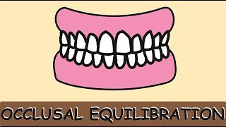 Occlusal Equilibration [upl. by Haela]