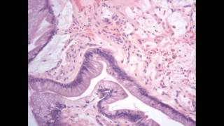 Histopathology Bladder Acquired Nonneoplastic Lesions Cystitis glandularis intestinal type [upl. by Lexa667]