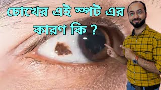 Brown spot on eyesConjunctival Nevus How to Remove Black Spot on white of Eye চোখের কালো দাগ eye [upl. by Annaul]