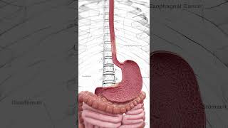 🔬 Understanding Esophageal Cancer Early Detection Is Key 🔬 anatomy [upl. by Arnuad]