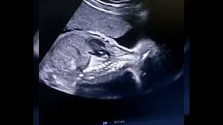 Sacrococcygeal teratoma in pregnancy ultrasound [upl. by Auroora]