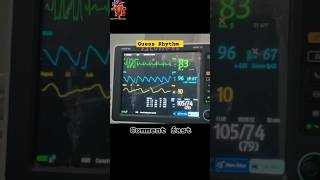 VPC In ECG venticular ectopic heartknowledge cathlab ytshorts ecg [upl. by Ynove811]