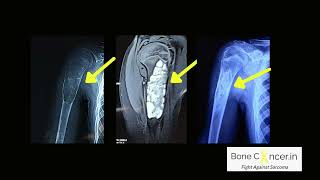 Treatment for Bone Tumour UnicameralSimple Bone CystCurettage amp Bone Allograft Dr Srimanth B S [upl. by Knah]