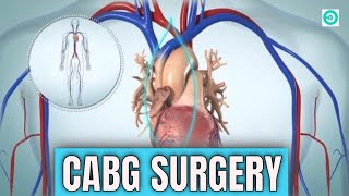 CABG coronary artery bypass graft Open Heart Surgery [upl. by Edmund]