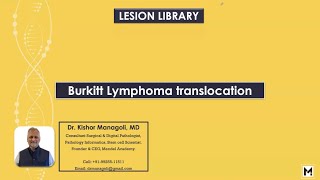 Pathology of Burkitt Lymphoma Translocation [upl. by Ataynek709]