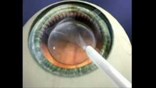 Explication Chirurgie refractive ICL Implant intraoculaire [upl. by Ripleigh284]