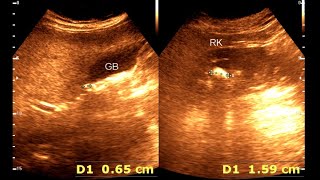 Fatty Liver  Cholelithiasis Renal stone ultrasonography [upl. by Zwiebel705]