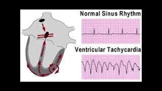 VENTRICULAR TACHYCARDIA PACE CARDIOLOGY [upl. by Andris]