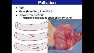 Surgery for Malignant Melanoma  Melanoma Education Symposium Mark Faries MD [upl. by Rehpotsrihc]