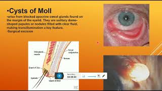 Non neoplastic lesions of the eyelid part 1 [upl. by Trinatte]