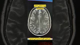 ورم سحائي حميد meningioma [upl. by Ayortal66]