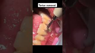 Tartar removal procedure [upl. by Queridas]