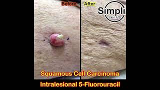 Squamous Cell Carcinoma Intralesional 5Fluorouracil [upl. by Dnaltiac455]