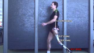 Amputee gait analysis with above knee prosthetic leg [upl. by Nauqal944]