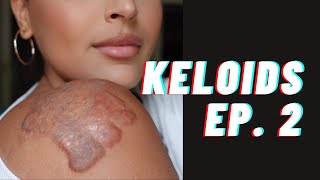 My Keloid Journey  Ep 2  Treatments amp Scar Camouflage at The Basma Hameed Clinic Toronto [upl. by Bibbie]