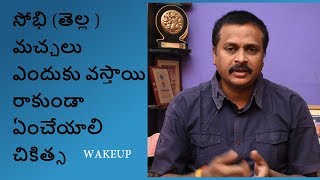 TINEAVERSICOLOR FUNGAL SYMPTOMS AND TREATMENT IN TELUGUHOMEOPATHYWAKEUP [upl. by Hebbe]