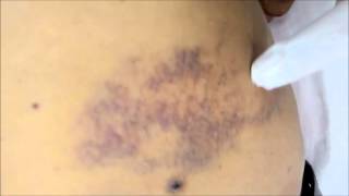 Bruise  Bruises meaning in Hindi Ecchymosis  Bluish discolouration of skin after trauma [upl. by Kartis703]