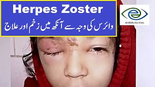 Herpes Zoster Ophthalmicus Symptoms and Treatment  UrduHindi [upl. by Lladnyk121]