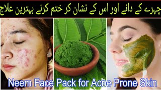 How To get Rid Acne Treatment At Home  neem benefits for skin  neem face pack for acne amp pimples [upl. by Yerok783]