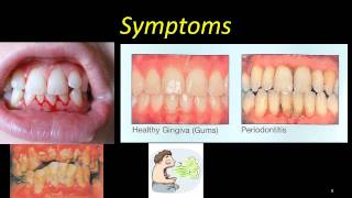 ANUG  severe gingivitis [upl. by Delainey922]