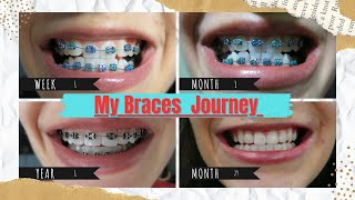 Braces monthly progress  Before and after Timelapse  Orthodontic treatment  your dentist braces [upl. by Ernald]