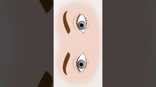 Animation of Horizontal Nystagmus seen in BPPV [upl. by Burtie718]