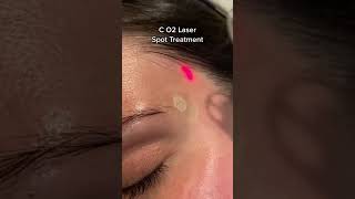 CO2 fractional laser treatment co2fractionallaser lasertreatment [upl. by Ledairam149]