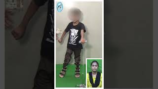 Dyskinetic cerebralpalsy child managed by therapy amp brace at trishla [upl. by Eseret]