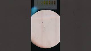 🎥Trichomoniasis Trichomonas in urine under 🎥📲Microscope Its Symptoms and sign With treatment [upl. by Atteniuq]