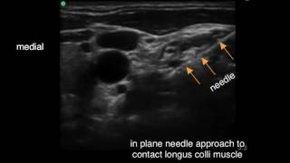 Cervical Sympathetic Trunk Block [upl. by Argyres]