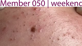 Acne Treatment Huong Da Nang 050  weekend  2023 [upl. by Ofori]