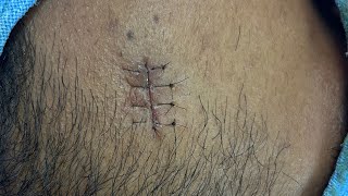 Vertical mattress suture skin closure technique suture technique [upl. by Arnon805]