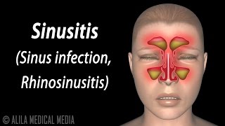 Sinusitis Animation [upl. by Bohrer]