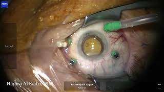 Vitrectomy for total rhegmatogenous retinal detachment with retinal folds und PVR [upl. by Nolana972]