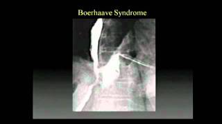 MANAGEMENT OF ESOPHAGEAL PERFORATIONS [upl. by Llemmart649]