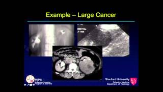 Imaging of Kidney Cancer Erik Mittra MD PhD Stanford University Radiology [upl. by Agustin484]