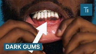 Why Some People Have Black Gums [upl. by Gromme]