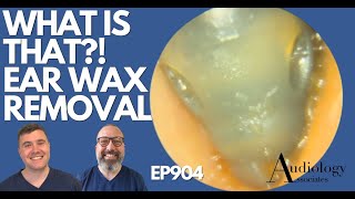 WHAT IS THAT EAR WAX REMOVAL  EP904 [upl. by Iddo]