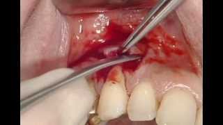 Tratamiento Periodontal Con Straumann Emdogain Efecto de Recesion [upl. by Iahs]