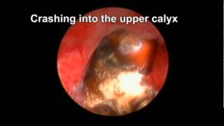 Complex case prone PCNL [upl. by Oicneconi]