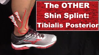 Treating the OTHER Shin Splint Tibialis Posterior [upl. by O'Callaghan]