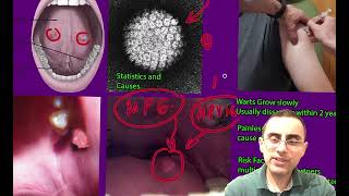 Oral Warts Explained Causes Symptoms and Treatments [upl. by Eelyab]