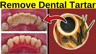 Remove Dental Tartar At Home NATURALLY [upl. by Sivartal408]