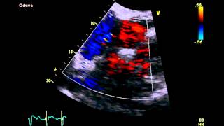 Patent Foramen Ovale  Transthoracic Echocardiogram TTE [upl. by Ainniz984]