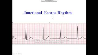 Junctional Escape Rhythm [upl. by Assiral]