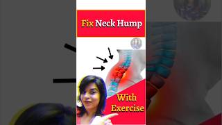 Best Exercises For Neck Hump  Get Rid Of Hump On Back Of Neck [upl. by Reivaj266]