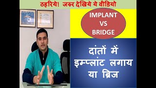 Dental Implant vs Bridge [upl. by Irwinn]