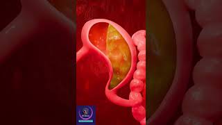 Gastroesophageal reflux disease  GERD Short Explanation [upl. by Zeta894]